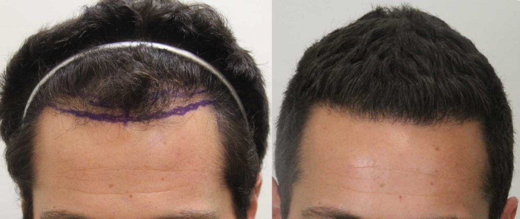 regrow hair in a bald spot